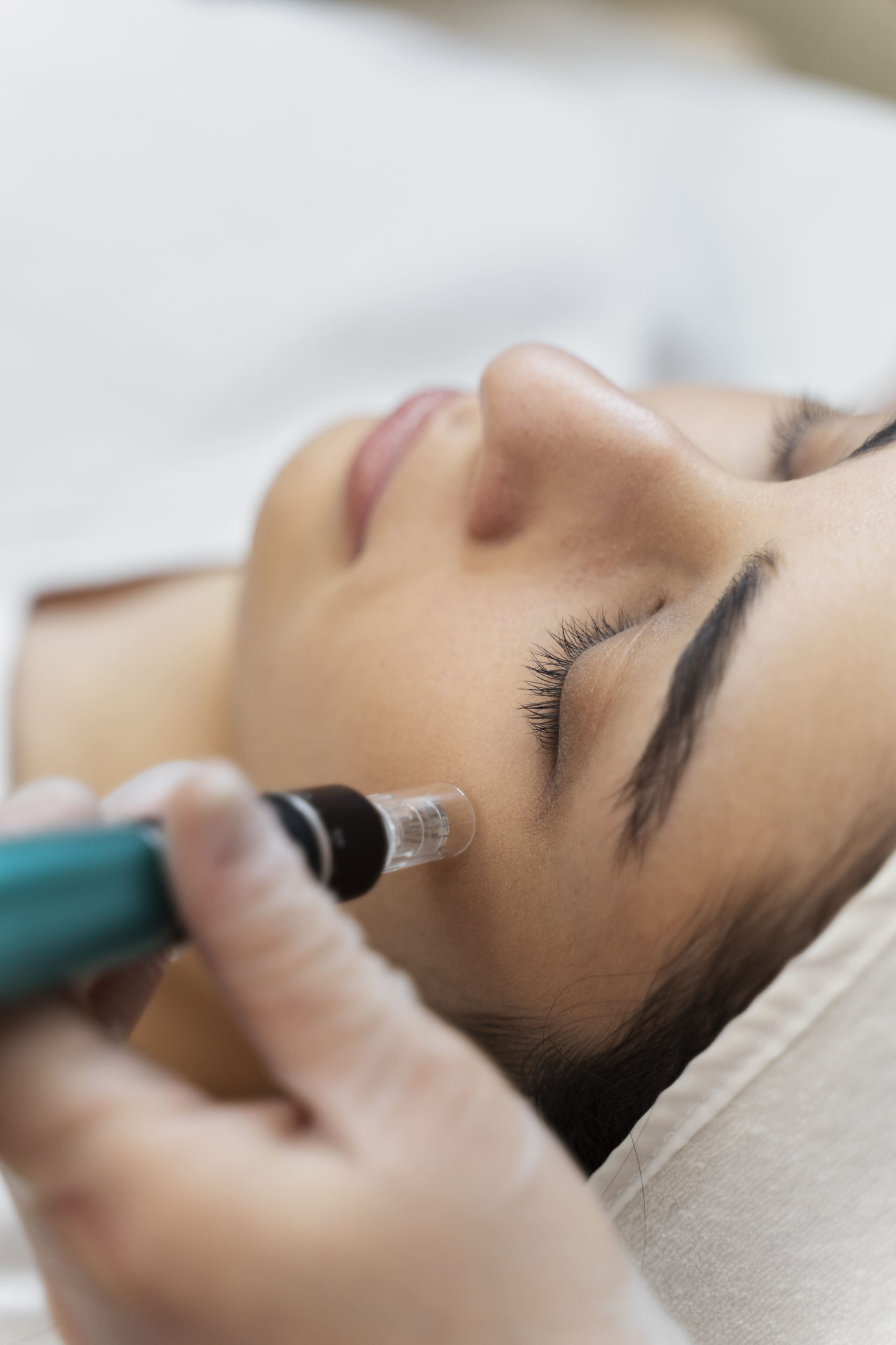 Microneedling Microneedling : dispositif médical et protocole personnalisé